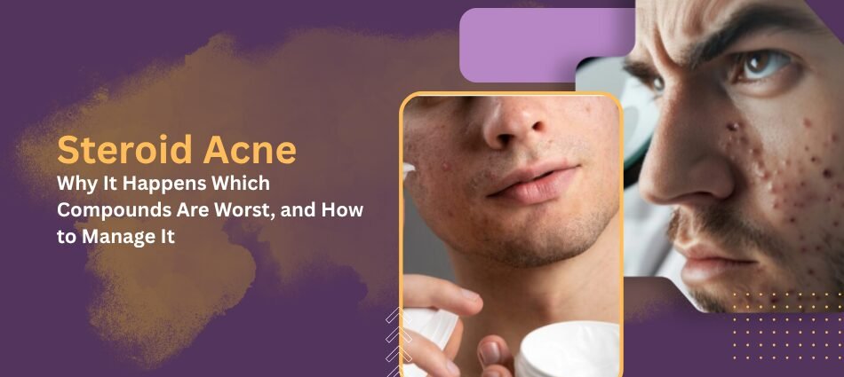 Steroid Acne: Why It Happens, Which Compounds Are Worst, and How to Manage It